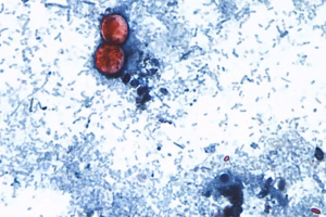CDC expands largest known U.S. cyclospora outbreak to 9 states, including Pennsylvania