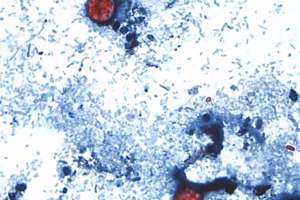 What to know about cyclosporiasis as the parasitic infection is found in 34 states